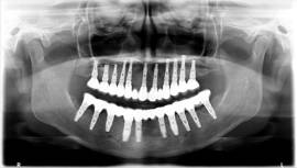צילום פנורמי בגמר הטיפול